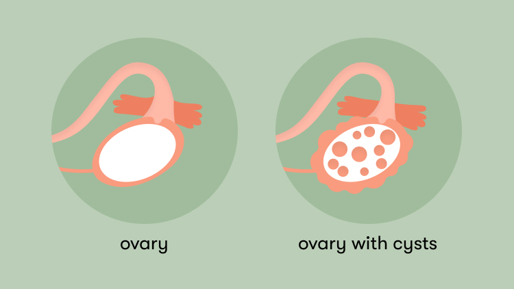 PCOS Quiz Flo pcos-quiz-flo